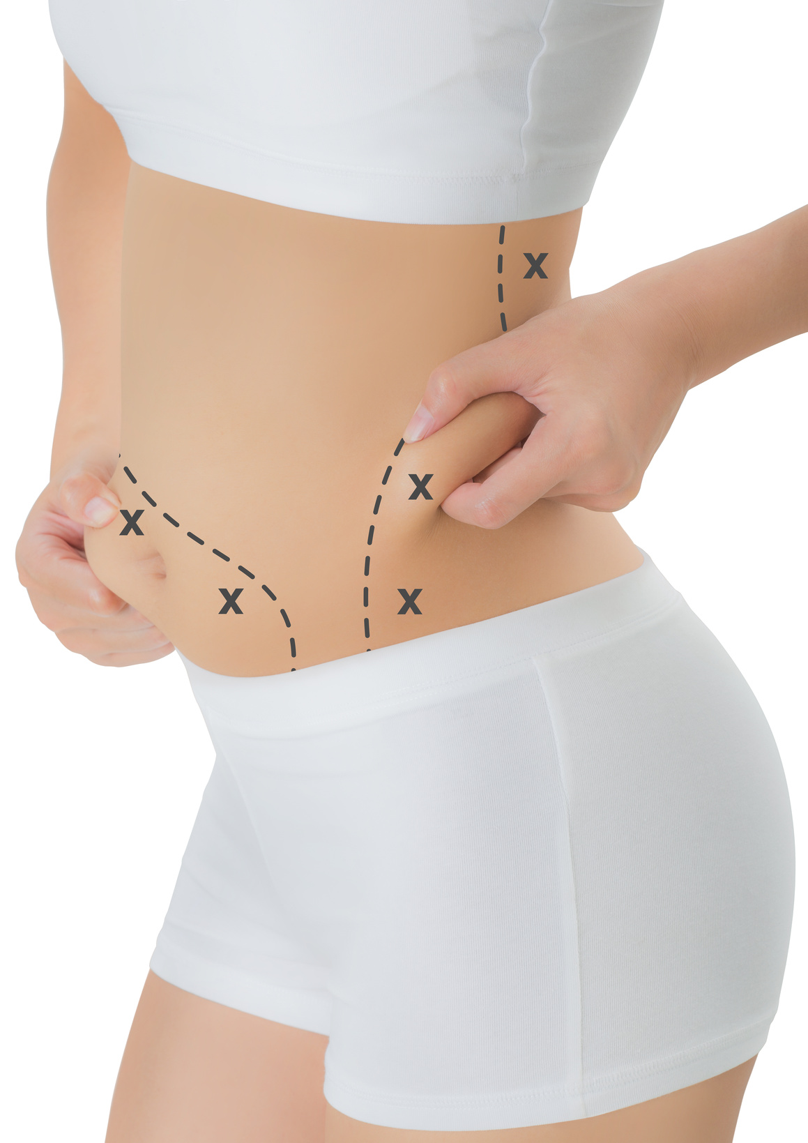 woman grabbing skin on her hip and belly with the black color crosses marking, Lose weight and liposuction cellulite removal concept, Isolated on white background.